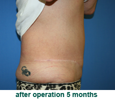 plastic-surgery-tummy-tuck